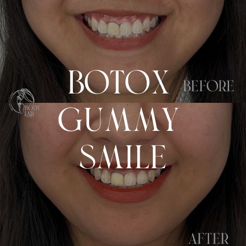 Botoxgummysmile